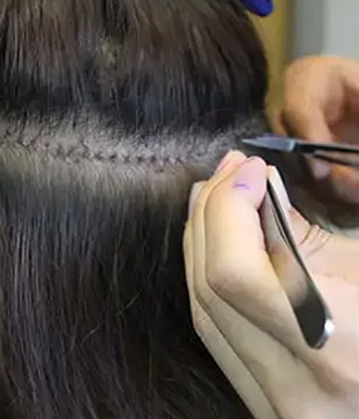 抜糸