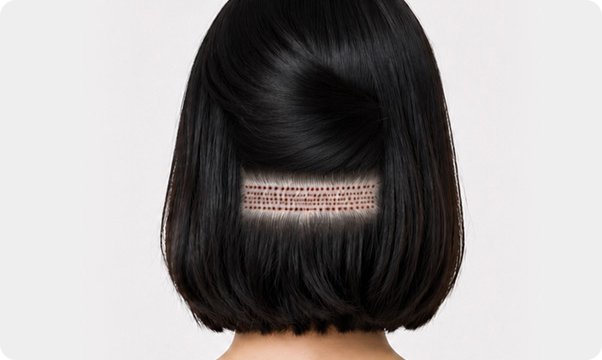 FUEヘアライン矯正