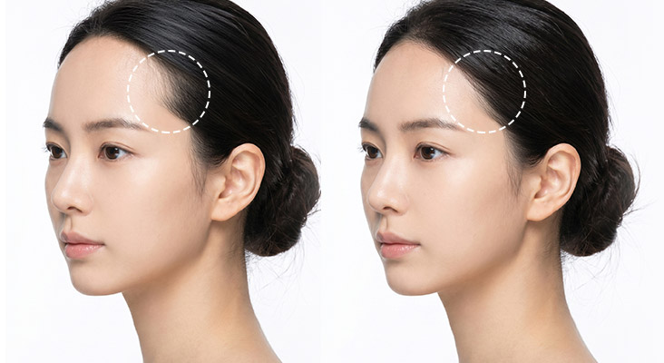 横顔まで考えたモジェリムのヘアライン矯正