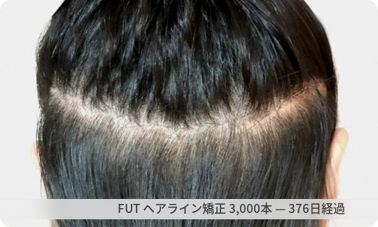 FUTヘアライン矯正の1年後