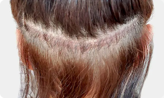 FUTヘアライン矯正の2週間後