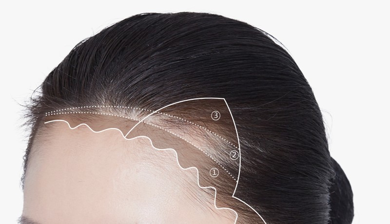 既存の毛流れを考慮したヘアラインデザインの例