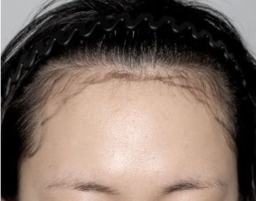 正面 · ロングヘア植毛の手術前