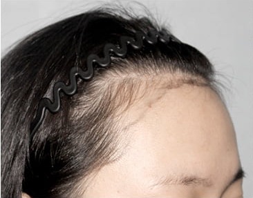 側面 01 · ロングヘア植毛の手術前