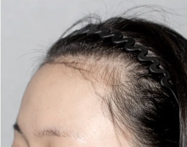 側面 02 · ロングヘア植毛の手術前