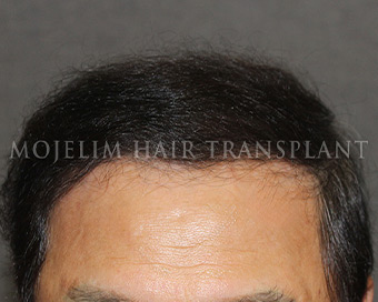 手術後・70代・症例3