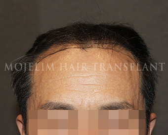手術前・60代・症例2