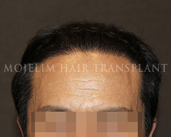 手術後・60代・症例2