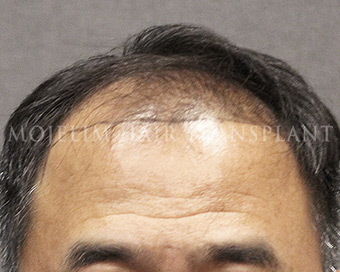 手術前・50代・症例3