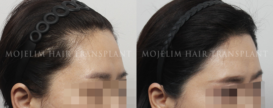 FUTヘアライン矯正 2,200本