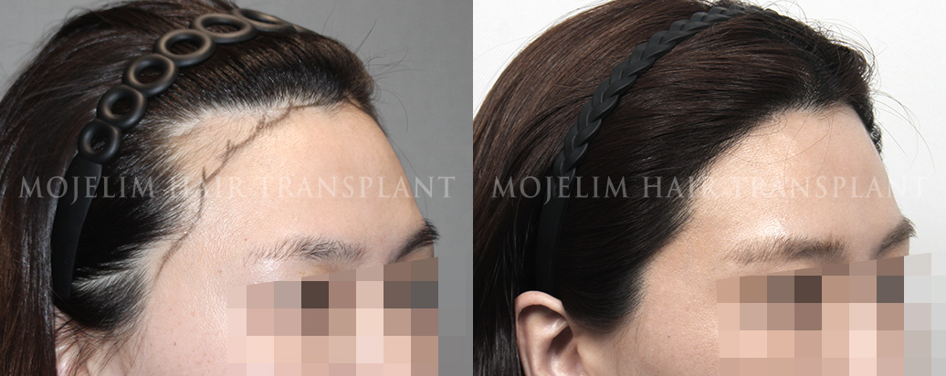 FUEヘアライン矯正 1,500本
