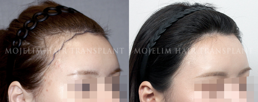 FUEヘアライン矯正 2,000本