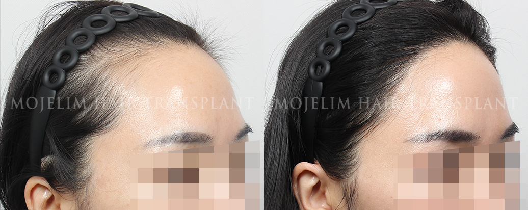 FUTヘアライン矯正 2,500本