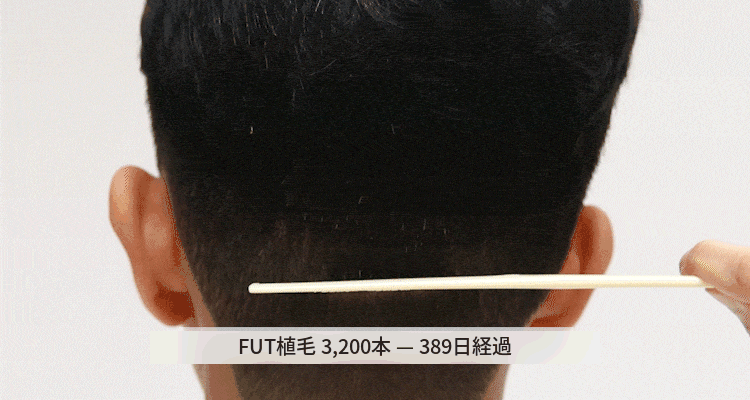 FUT手術の1年後